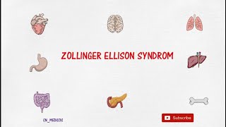 Zollinger Ellison Syndrome  Pathophysiology Clinical Menifestation Diagnosis and Treatment  ZES [upl. by Wojcik]