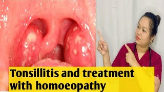 Tonsillitis😱😱signs amp symptoms and its treatment with homoeopathy ✅🍀💯 [upl. by Stein]