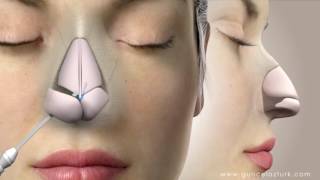 Rhinoplasty Nose Job Video Animation  Guncel Ozturk MD  DRGO [upl. by Watkins940]