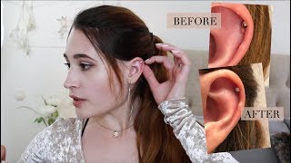 How I Treated My Hypertrophic Scar on Helix Piercing with photos [upl. by Ajup]