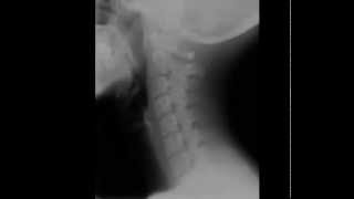 Cervical Spine Radiology Tutorial [upl. by Notak]