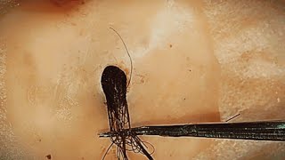 Removal of ingrown hair [upl. by Wendt411]