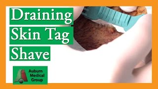 Shave Biopsy of Skin Tag with Sebaceous Cyst  Auburn Medical Group [upl. by Gannie341]