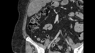 Lipomatosis of the ileocecal valve [upl. by Lipp]