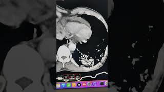 Pulmonary sequestration with small thoracic aorta branch [upl. by Bultman]