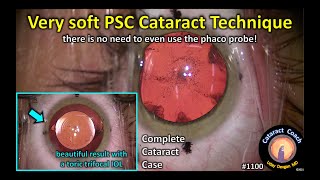 CataractCoach 1100 technique for very soft PSC cataract surgery [upl. by Neram]