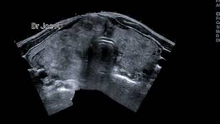 Huge multinodular goiter of thyroid ultrasound and color Doppler video thyroid enlargement [upl. by Yanat]