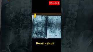 Intravenous urography IVU showing hydronephrosis amp renal calculihydronephrosis renalcalculi [upl. by Nodnek]