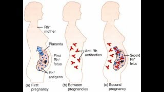 GENETICS  ERYTHROBLASTOSIS FETALIS HDNB RS CREATIONS [upl. by Ynatterb]