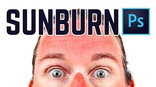 Tips for sunburn 🔥in Darker Skin👩🏾‍⚕️ [upl. by Chrisse]