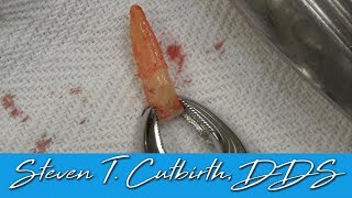 Extracting Mandibular Anterior Tooth  Dental Minute with Steven T Cutbirth DDS [upl. by Brandyn]