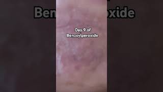 Day 9 of Benzoylperoxide Benzoylperoxide combinationskin skincare acne acnescars viralshorts [upl. by Latif]