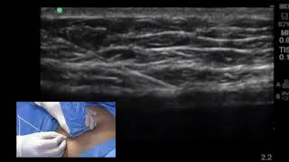 The UltrasoundGuided Rectus Sheath Block RSB [upl. by Eecyac]