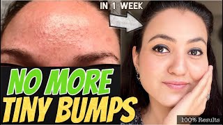 1 WEEK CHALLENGE 💕 GET RID OF TINY BUMPS NATURALLY in just 7 Days and Get Amazing EVEN SKINTONE [upl. by Yecram450]