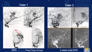 Stereotactic Radiosurgery for Arteriovenous Malformations with Hemorrhage History [upl. by Rita357]