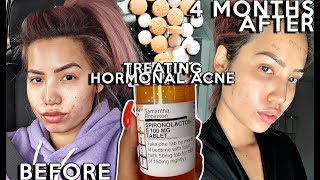 Treating my Hormonal Cystic Acne with Spirolactone  4 MONTHS Before amp Afters  ProsCons [upl. by Ogilvy170]