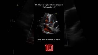 Echocardiography Question 1 [upl. by Cavuoto]