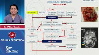 Enterocolitis necrotizante CIRUGÍA PEDIATRÍA INDICE DESCRIPCIONETIOLOGIACLINICATTO QXMEDIC [upl. by Acirfa203]