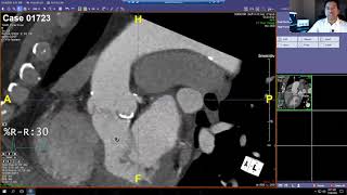 Cardiac CT for TAVR [upl. by Ocsisnarf]