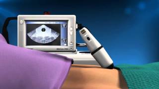 Cubescan BioCon700 Bladder Scanner  Reduce Urinary Tract Infections UTI [upl. by Aicirtam]