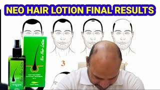 Neo Hair Lotion Minoxidil Final Results After 2 Yars [upl. by Elaina]