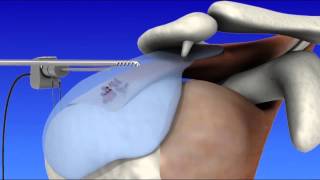 Shoulder Arthroscopy [upl. by Azitram586]