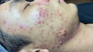 ACNE TREATMENT VU QUYNH MI Blackheads On Boy Face 2024 [upl. by Senhauser]