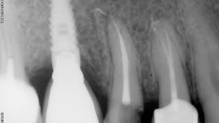 Endodoncia completa premolar superior [upl. by Willock]