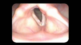 Vocal cord paralysis with nodules [upl. by Redmond]