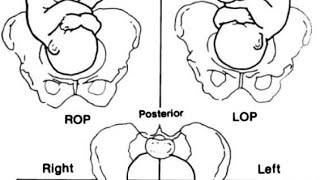 اسهل طريقة لتحديد malposition and malpresentation  مادة توليد obstetrics [upl. by Philipson]