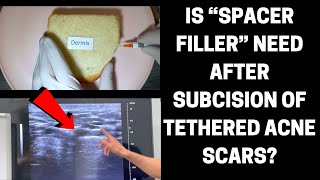 Is “Spacer Filler” Needed After Subcision Of Tethered Acne Scars [upl. by Drugi]