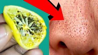 सर्फ 5 मिनट में ब्लैकहेड्स और वाइटहेड्स खत्म करें blackheads amp whiteheads remove fast in 5 minutes [upl. by Mellman]