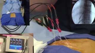 Radiofrequency Ablation Explanation Video Demonstration  LIVE [upl. by Yule]