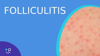 Folliculitis  Daily Dos of Dermatology [upl. by Ravid]