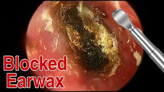 BIGGEST Ear Wax Difficult Removal  EP5  Doctor Anh [upl. by Darn330]