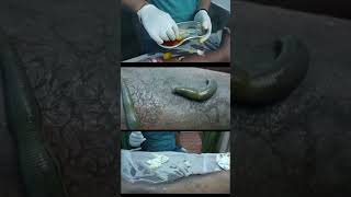 Psoriasis Relief with Leech Therapy [upl. by Hau]