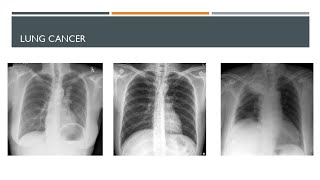 Chest Xray in Lung cancer part 1 cxr cancer radiology [upl. by Ronnica]