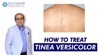 Tinea versicolor  Dr Rohit Batra  Tinea Versicolor Treatment  How to treat Tinea Versicolor [upl. by Siaht]