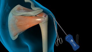 ConMed Linvatec Rotator Cuff Shoulder Surgery [upl. by Atikaj]