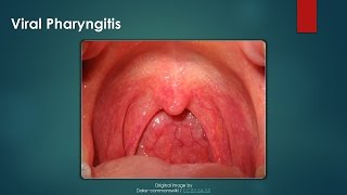 Viral Pharyngitis [upl. by Player165]