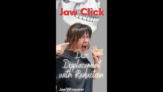 What Is A Jaw Click tmd tmj jawclick [upl. by Olenolin]