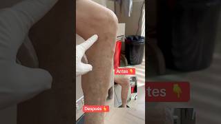 🏩 escleroterapia varices varicosevein arañasvenenosas 📲593995178395 [upl. by Ailero867]