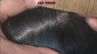 Dandruff Scratching  Dry Flaky Scalp \ Huge Flakes \Scalp Scratching 11 [upl. by Downing]