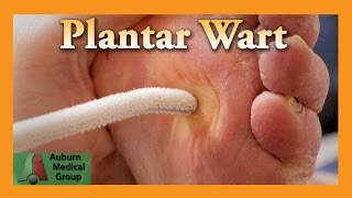 Plantar Wart Treatment  Auburn Medical Group [upl. by Mccreery]