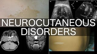 Neurocutaneous Disorders [upl. by Naihr]