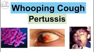 Whooping Cough Pertussis  Transmission Pathophysiology Symptoms Diagnosis Treatment [upl. by Cicely]