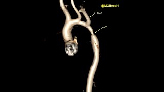 Coarctation of aorta [upl. by Ettener969]