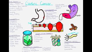 Understanding Gastric Cancer risk factors symptoms diagnosis treatment precancerous lesions [upl. by Sucy]