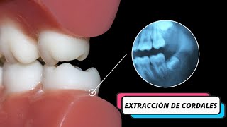 Cirujana especialista Extracción Cordales  Maxilofacial ¿En qué casos se requiere esta cirugía [upl. by Efram19]