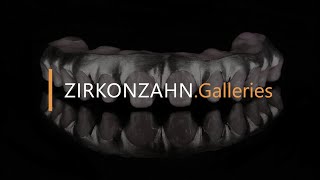 Prettau® 4 Anterior® zirconia on titanium  ZirkonzahnGalleries [upl. by Gunar683]